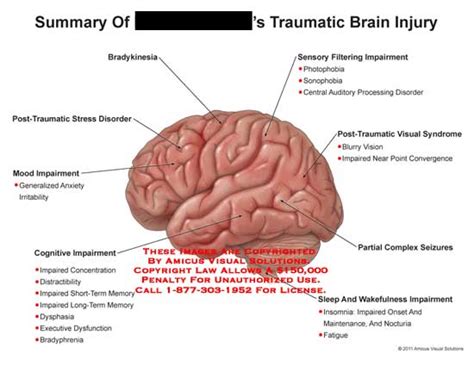 AMICUS Illustration Of Amicus Injury Brain Traumatic Bradykinesia Post