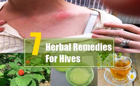 7 Herbal Remedies For Hives Search Home Remedy