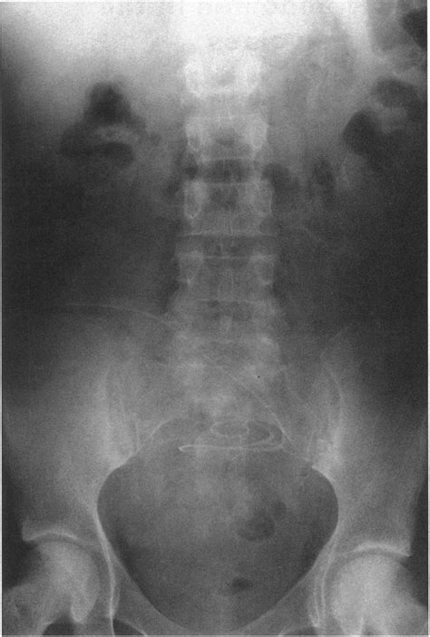 Plain Abdominal X Ray Showing Calcification In Left Upper Quadrant