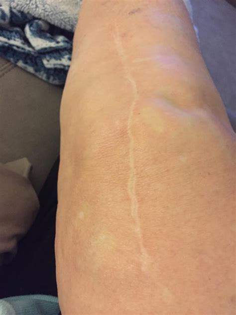The preferred sites for gifs to be hosted on are imgur or gyfcat. Knee Replacement Scar Recovery Timeline: A Photo Gallery