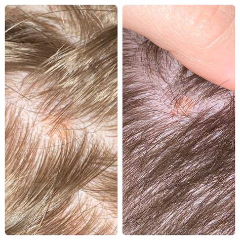 Albums 92 Pictures Photos Of Melanoma On Scalp Latest
