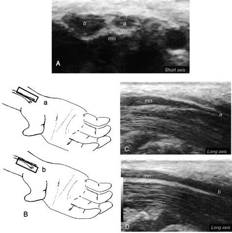 Sonographic Assessment Of A Bifid Median Nerve And Median Artery In