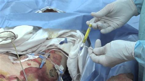 Escharotomy allows the cutaneous envelope to become more compliant. Escharotomy Procedures for Burn Patients - YouTube