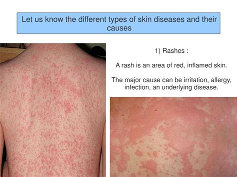 Ppt Different Types Of Skin Diseases And Their Causes Powerpoint Presentation Id7173361