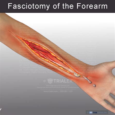 Fasciotomy Of The Forearm Trialexhibits Inc