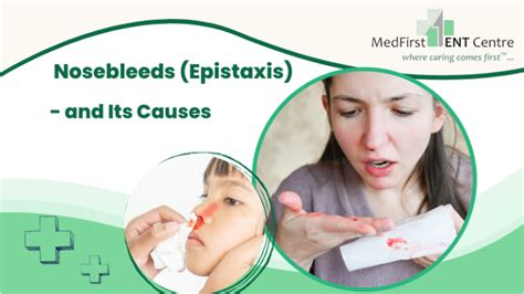 Preventing Nosebleeds Epistaxis Treatment Options Ent