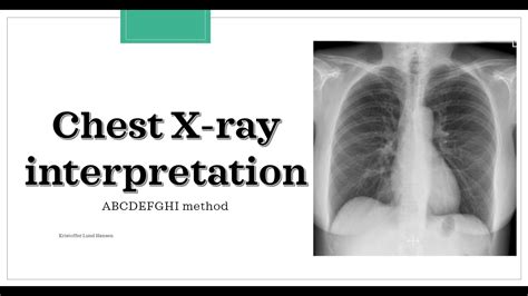 Chest X Ray Interpretation Abcdefghi Method Youtube