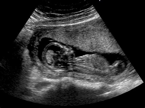This scan and nuchal translucency scan/dating scan, a potential genetical problem. 12 Weeks Pregnant - Indusladies.com