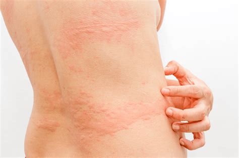 Skin Rashes Facts Types Causes Complications And Treatment Factdr