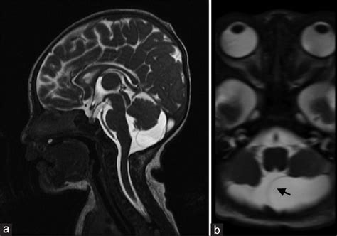 Rare Case Of A Rapidly Enlarging Symptomatic Arachnoid Cyst Of The