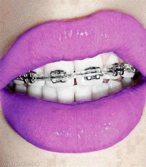 Love This Shade Of Lipstick It Would Also Look Good With The Braces I