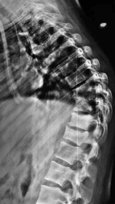 X Ray Showing A Significant Kyphosis 6 Months After Hardware Removal