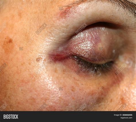 Bruise Near Eye Image Photo Free Trial Bigstock