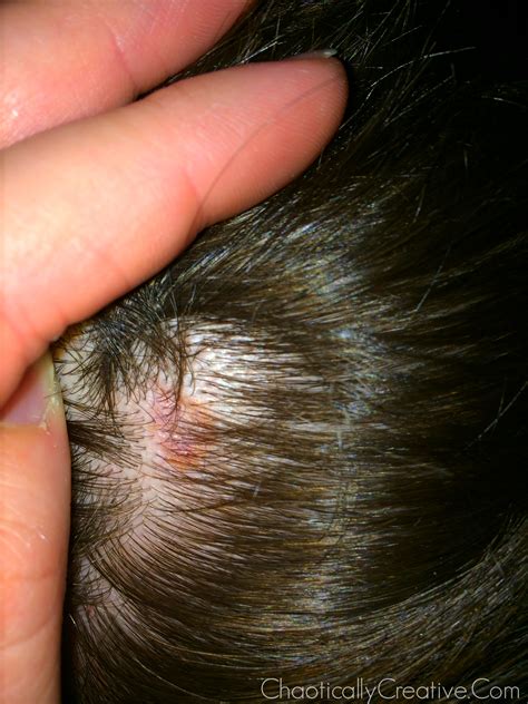 Scalp Cancer Images Pictures Of Skin Cancer On Head Sydneycrst