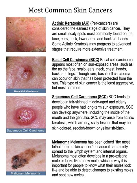 Stages Of Skin Cancer