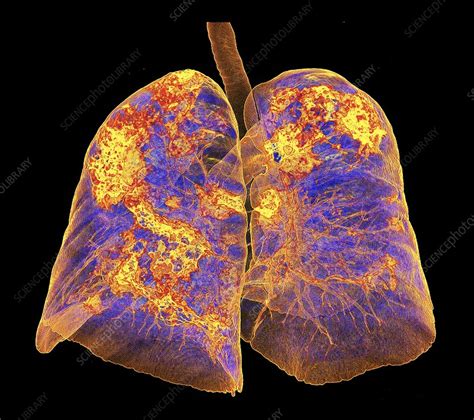 Lungs Affected By Covid 19 Atypical Pneumonia 3d Ct Scan Stock Image