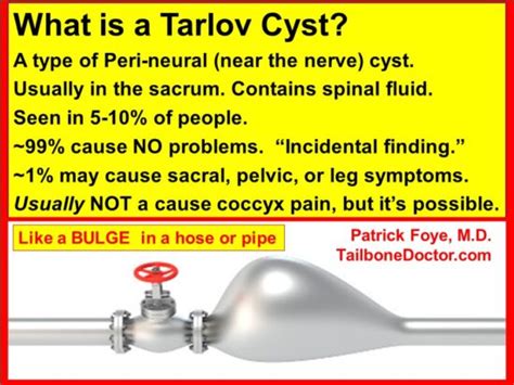 Do Tarlov Cysts Cause Pain Tailbone Doctor