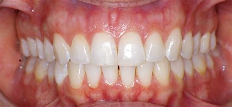 Because of the natural tendency of the teeth to shift, dentists strongly urge their patients to wear retainers after invisalign treatment. Is Invisalign Right for You? What you need to know about ...