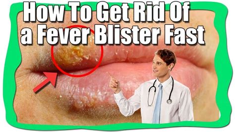 How To Get Rid Of A Fever Blister Overnight Cold Sore Remedy