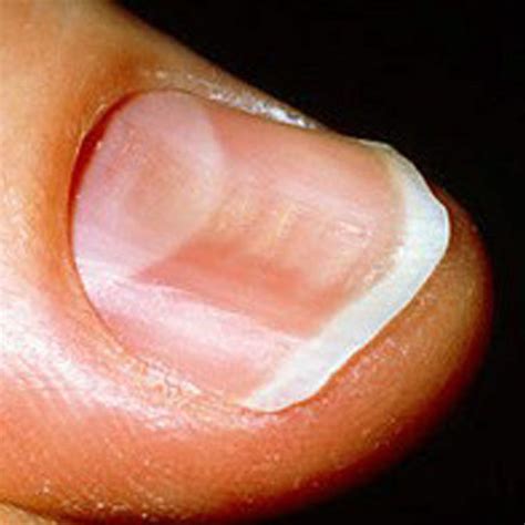 9 Things Your Fingernails Reveal About Your Health Nail Problems