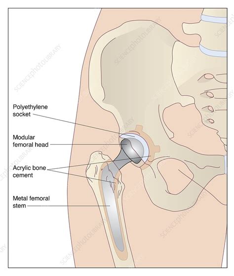 Hip Replacement Artwork Stock Image C008 5326 Science Photo Library