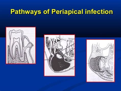 Odontogenic Infection