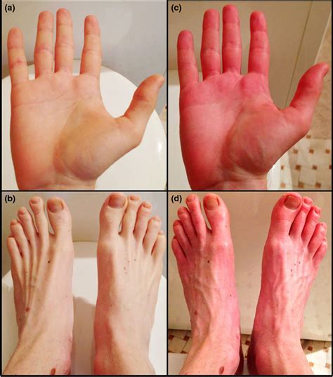 Secondary Erythromelalgia A Tryptophan Dietary Supplement Induced Case