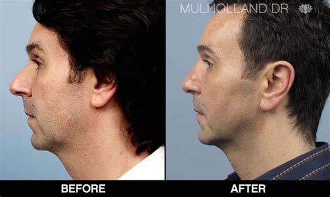 male rhinoplasty nose job in toronto dr thomas bell