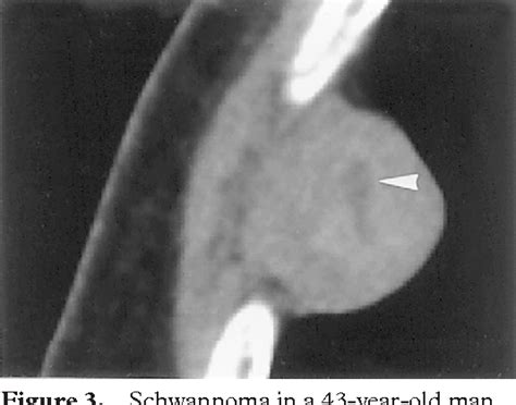 Figure 1 From Chest Wall Tumors Radiologic Findings And Pathologic