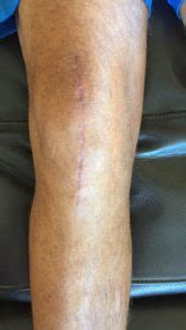 Browse 11 knee replacement scar stock photos and images available, or start a new search to explore more stock photos and images. 2 Months After TKR Surgery (Scars, Pain, and Progress)