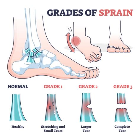 The Different Types Of Ankle Sprain Ankle Ankle Sprains And More