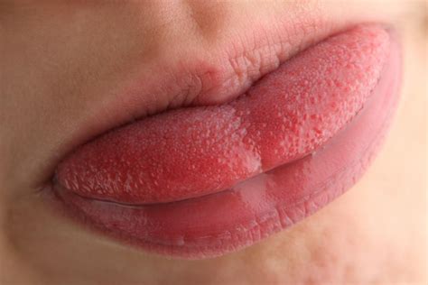 Swollen Taste Buds Causes Diagnosis And Treatment