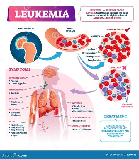 Symptoms Of Leukemia Vector Illustration 70924356