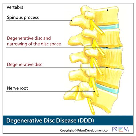 Degenerative Disc Spine Group Orlando