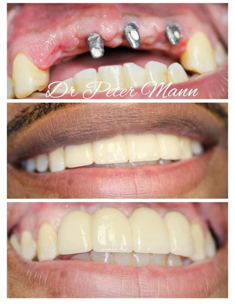 Dental Implants Nyc Manhattan Dentist Best Dentist