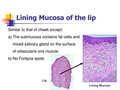 Fordyce Spots Oral Mucosa