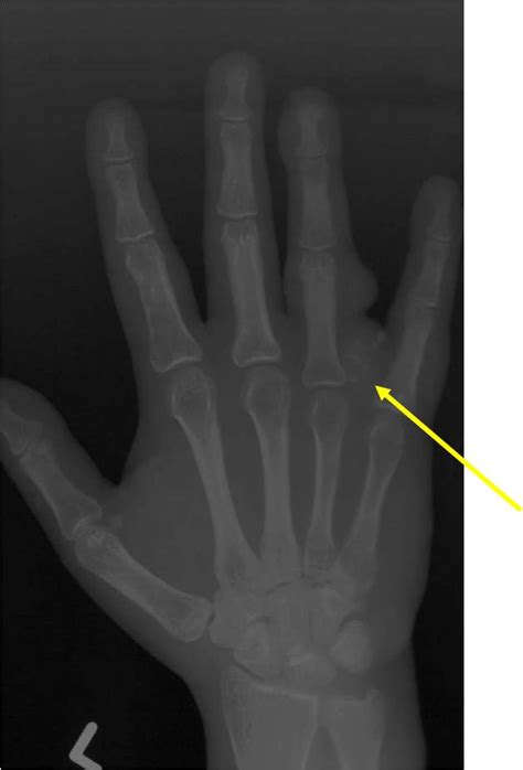 Enchondroma Benign Bone Tumor Tumors Of Bone