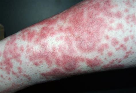 Diabetic Skin Rash Pictures Symptoms And Pictures