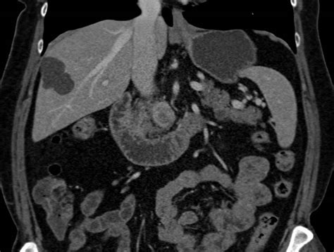 Pancreatic Cancer In Head Of Pancreas And Multiple Intraductal