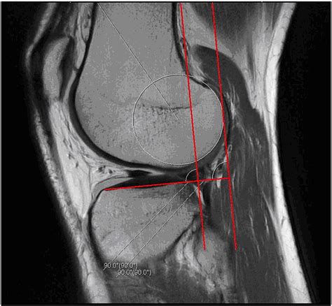 Notchplasty In Anterior Cruciate Ligament Reconstruction In The Setting