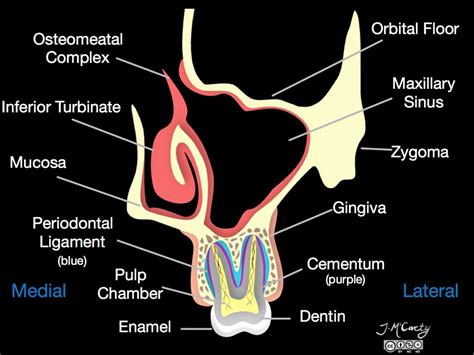 Maxillary Sinus Illustration Radiology Case