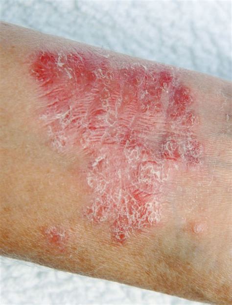 Eczema Skin Treatment What Is The Best For Rash Tips Include Cream