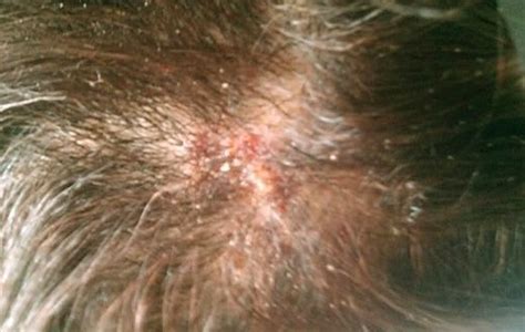 Red Bumps On Scalp Small Itchy Bumps On Scalp Painful