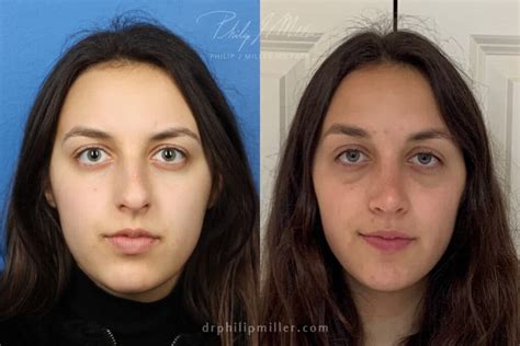 Crooked Nose Correction In New York