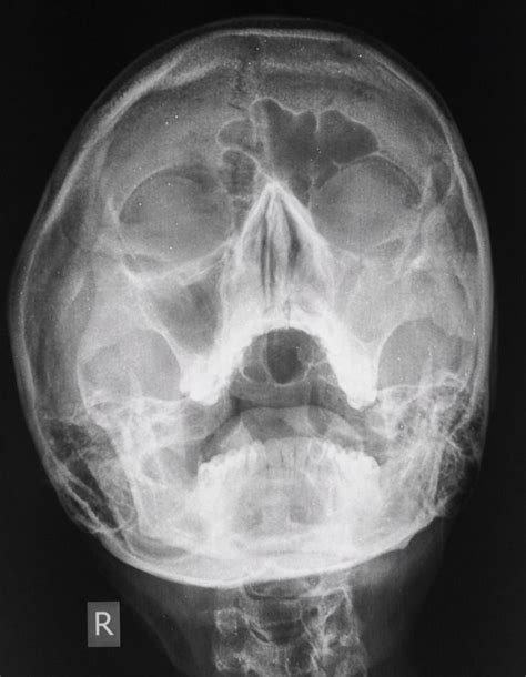Maxillary Sinusitis Radiology Case Radiology Sinusitis Radiology Imaging