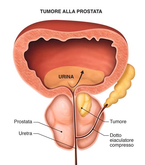 Tumore Prostata Cos Sintomi E Cure Gvm