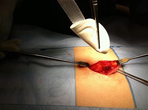 Prof Chris Berney Open Umbilical Hernia Repair