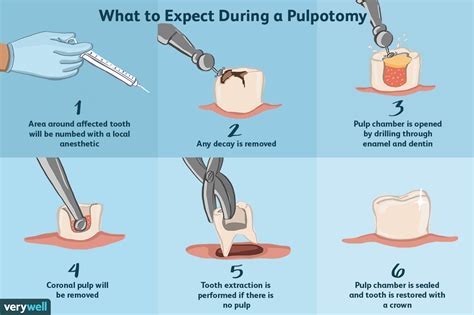 Pulpotomy Uses Side Effects And Procedure
