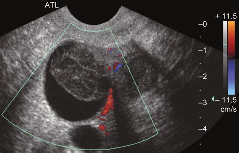 Transvaginal Ultrasound Of The Adnexa Note Cystic Structure With A