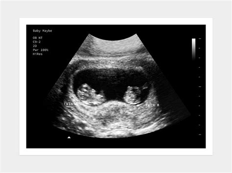 8 Weeks Twins Fake Ultrasound W Instant Download